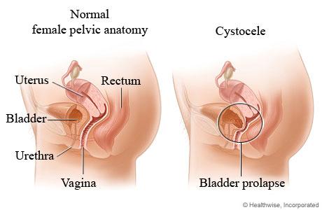 Cystocèle