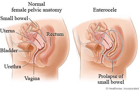 Le prolapsus pelvien