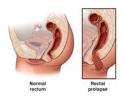 Prolapsus rectal