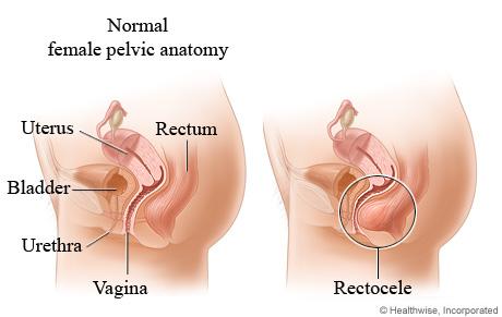 Rectocèle